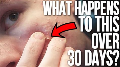Pop A Big Zit Or Cyst And See What Happens Month Timeline Youtube