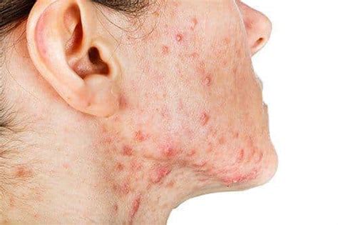 Cystic Acne Treatment Singapore Advice From A Doctors Perspective