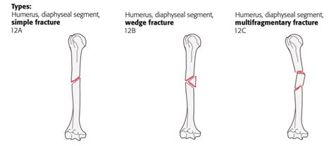 Aoota Classification Of Humeral Shaft Fracture Types Copyright By Ao