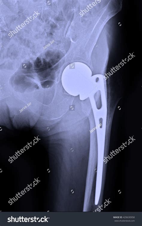 Xray After Total Hip Replacement View Stock Photo 429630958 Shutterstock