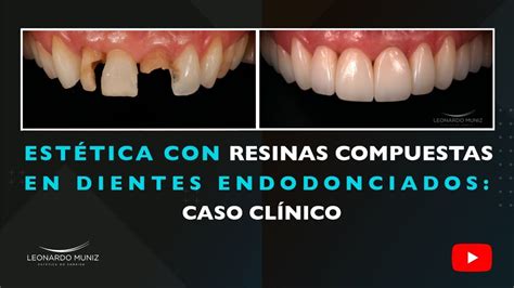 Estética Con Resinas Compuestas En Dientes Endodonciados Caso Clínico