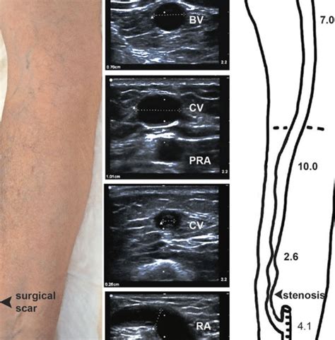 Layers Of Forearm Ultrasound