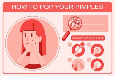 How To Pop Pimple Infographics Vector Cartoon Illustration Cartoon