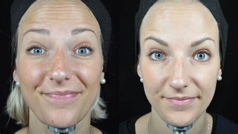 The New Baby Botox This Is Exactly What Happens To Your Face Healthista