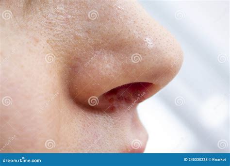 Herpes On The Nose Pretty Caucasian Woman With Herpes Her On Nose