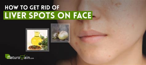 How To Get Rid Of Liver Spots On Your Face Remove Age Spots Fast