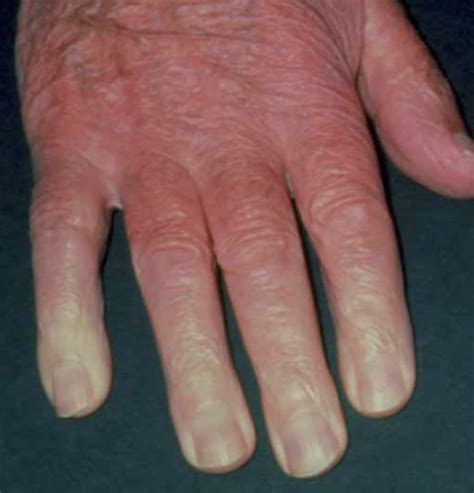 Managing Raynauds Phenomenon The Pharmaceutical Journal