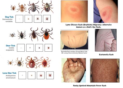 Tick And Rash Pictures Ticks Lyme Disease Tick Rash
