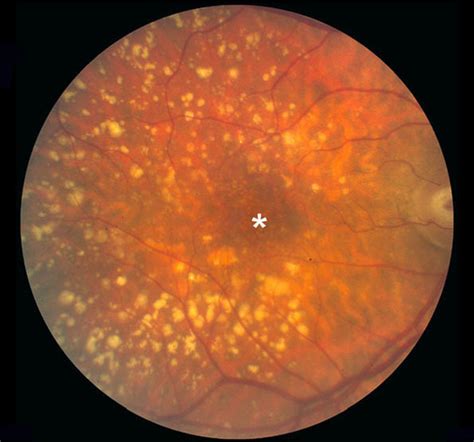 Figure 6 Color Fundus Photograph From An Webvision Ncbi