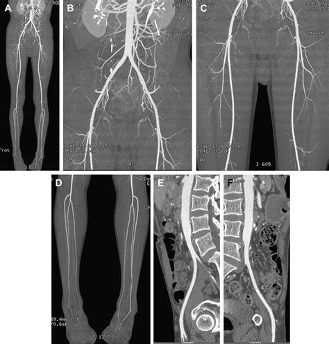 Ct Angiography Of The Lower Extremities Radiologic Clinics