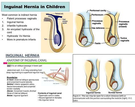 Approximately one half of inguinal hernias manifest in the female infant, the ovary and fallopian tube can be contained within the hernia sac, presenting as a firm, discrete, nontender mass in the labia. Right Indirect Inguinal Hernia - Broken Curve