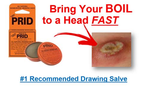 Pin On Getting Rid Of Boils Fast