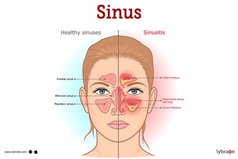 Sinus Human Anatomy Picture Functions Diseases And Treatments
