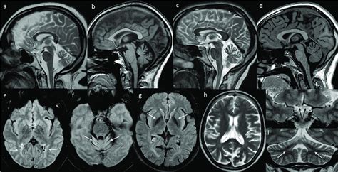 Brain Magnetic Resonance Imaging Mri Findings Sagittal T2 A