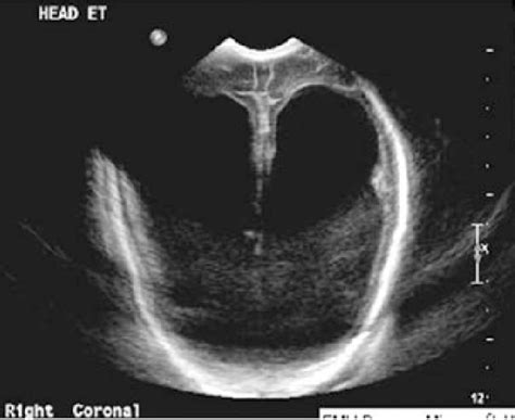 Cranial Ultrasound From The Infant In Our Case Showing Severe