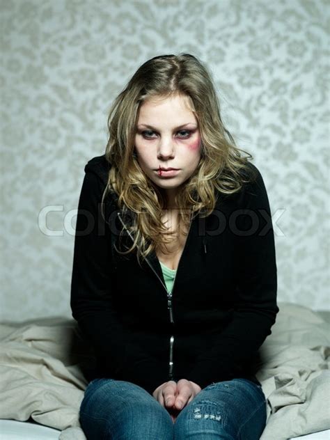A Teenage Girl With Bruises On Her Face Stock Photo