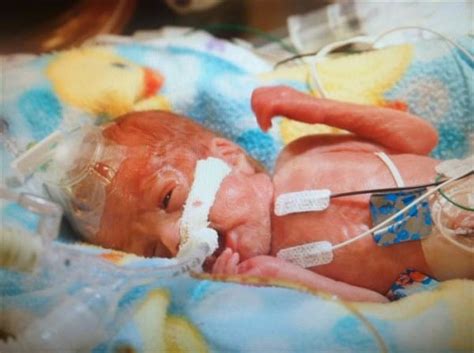 Born 6 Months Early Experts Said This Baby Would Surely Die But What