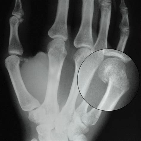 Surgical Indications And Treatment Of A Metacarpal Fracture