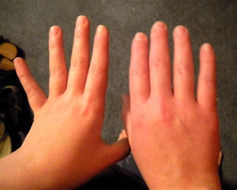 Red Swollen Hand Pictures Photos