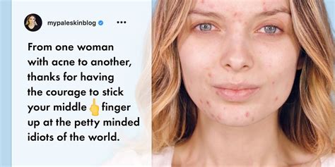 Why People Are Posting Acne Photos On Instagram Skin Positivity