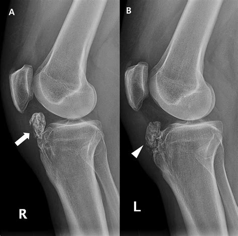 X Rays Of Osgood Schlatters Disease Captions Trend Update