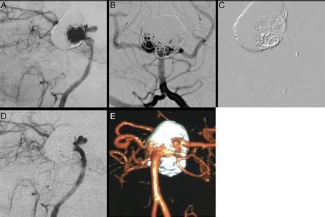 Treatment Of Wide Necked Basilar Tip Aneurysm Not Amenable To Y