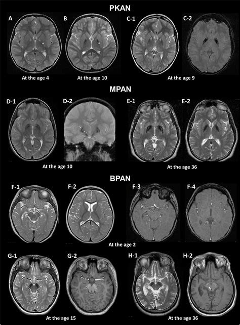 Frontiers Brain Mri Pattern Recognition In Neurodegeneration With