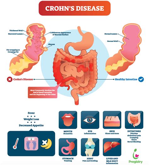 Crohns Disease The Pulse