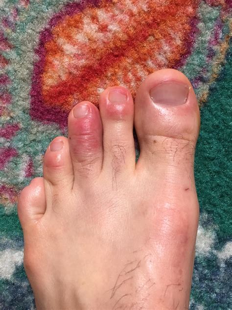 Can Somebody Help Me Identify This Rash On My Toes Rmedical