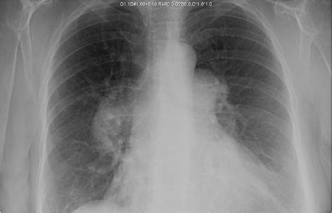 70 Year Old Woman With Progressive Dyspnea And Dilated Pulmonary Arteries