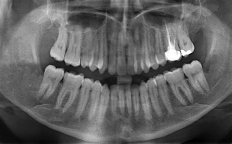 Cureus Bilateral Dentigerous Cyst In Impacted Mandibular Third Molars