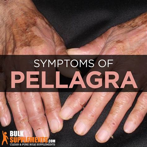 Pellagra Symptoms Causes And Treatment By James Denlinger Medium