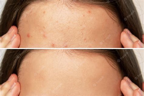 Premium Photo Cropped Shot Of A Young Womans Face Before And After Acne Treatment On Forehead