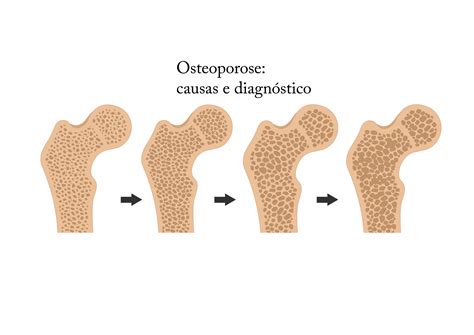 O Que Causa A Osteoporose