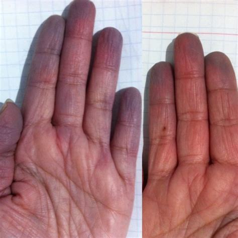 10 Facts You Didnt Know That Are A Part Of Life For Those With Raynauds Disease