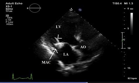 A Mitral Annular Calcificationrelated Calcified Amorphous Tumor In End