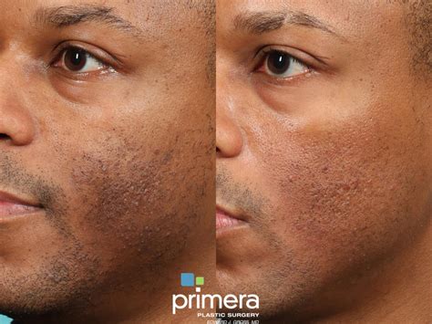 Fraxel® Laser Before And After Pictures Case 619 Orlando Florida