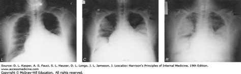 Legionnaires Disease On Chest Radiograph Accessmedicine Network