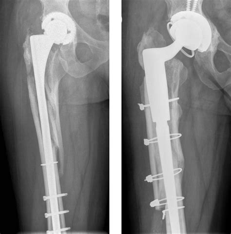 Revision Total Hip Replacement — Constant Busch
