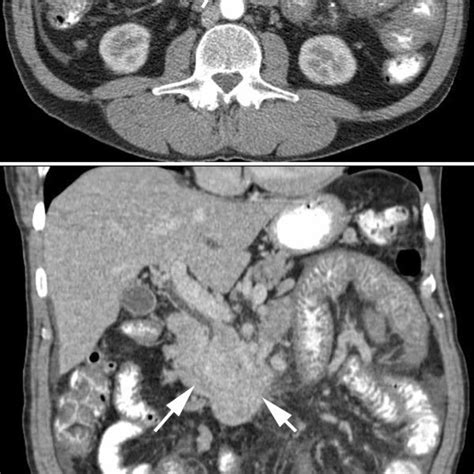 Preoperative Abdominal Ct Scan Demonstrating Large Mesenteric Soft