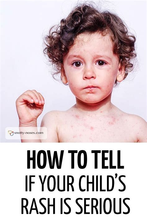 An Unwell Boy With A Rash Typical Of A Viral Xanthoma Childhealth