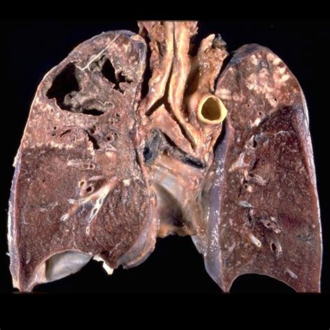 Cavitating pulmonary tuberculosis: gross pathology | Image