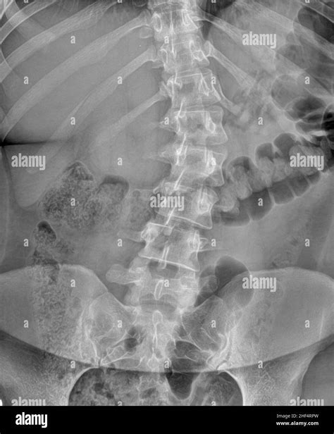 Lumbar Spine Radiography In Anteroposterior Projection Of A Patient