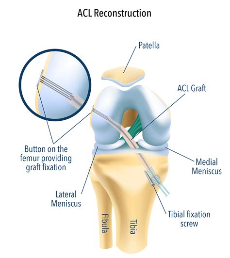 Difference Between Acl Reconstruction And Repair Best Design Idea