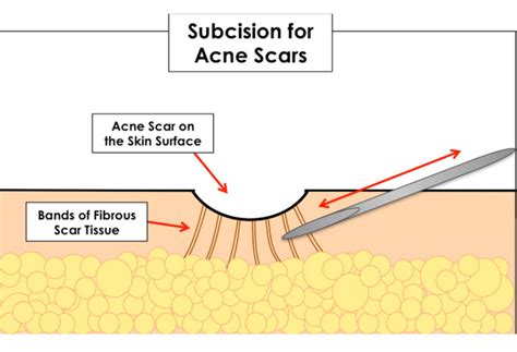 Cicatrici De Acnee Clasificare Si Optiuni De Tratament Skin Clinic