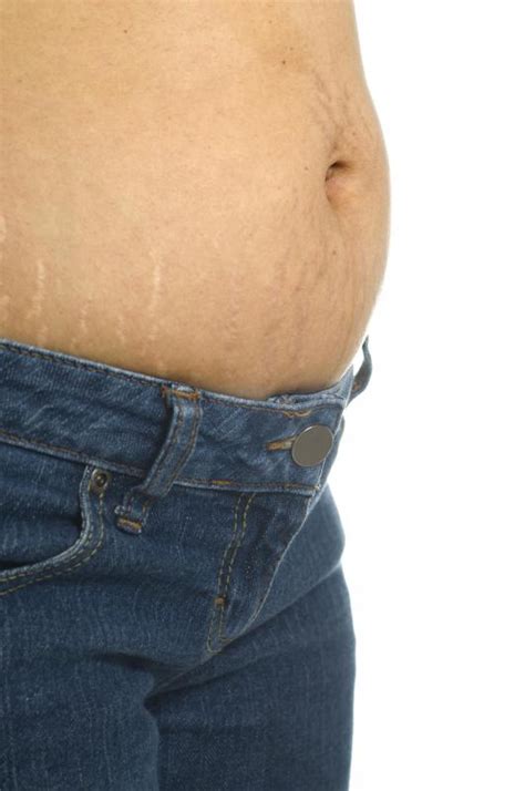 What Is The Best Way To Get Rid Of Stretch Marks