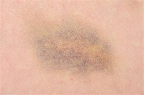 Child Abuse Bruise Stock Photos Pictures And Royalty Free Images Istock