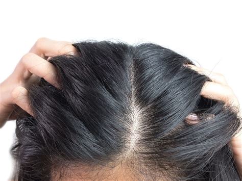 Scalp Psoriasis What Dermatologists Wish You Knew Best Health