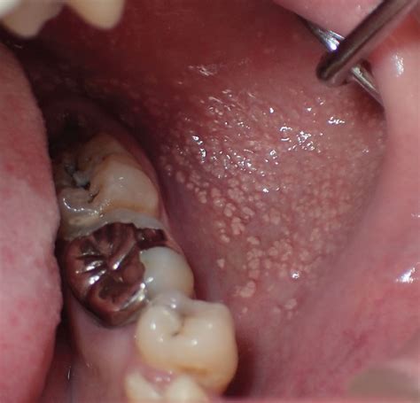Asymptomatic Granules On The Buccal Mucosa Cleveland Clinic Journal