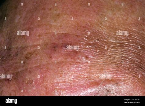 Close Up Of A Shingles Rash On The Forehead In A 72 Year Old Male
